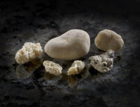 Виды камней в почках — фото и описание