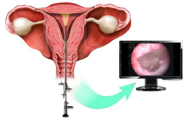 Диагностическая гистероскопия матки