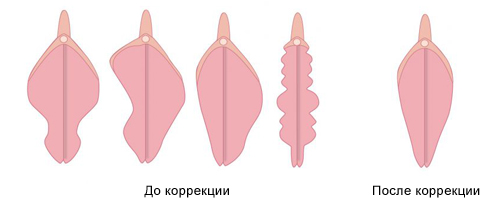 Пластика малых половых губ в Москве - цены и фото до и после