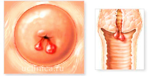 Полип эндометрия матки