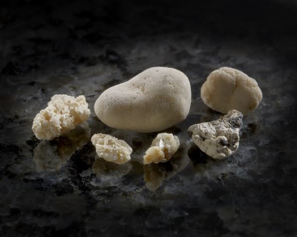 В зависимости от причины появления камни в почках делятся на несколько типов