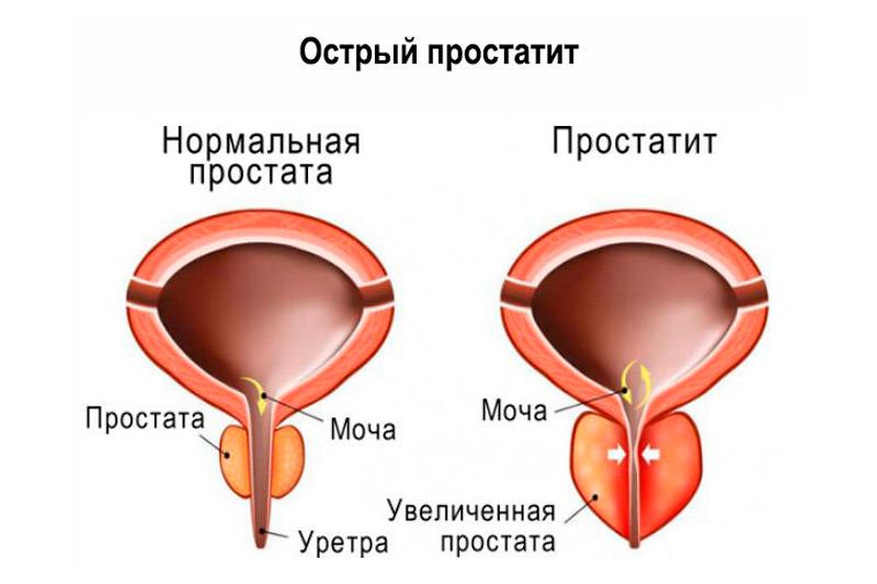 Меры профилактики, чтобы не было простатита