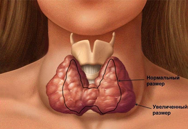 Заболевания щитовидной железы.jpg